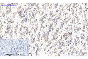 Immunohistochemical analysis of paraffin-embedded human liver cancer tissue. (CaMKIIbeta/gamma/delta antibody  (pThr287))