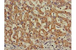 Immunohistochemistry of paraffin-embedded human liver cancer using ABIN7156331 at dilution of 1:100 (Insulin Receptor antibody  (AA 1023-1298))