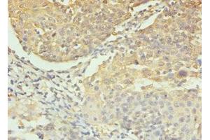 IHC analysis of paraffin-embedded human colon cancer, using Caspase 3 antibody (1/100 dilution). (Caspase 3 antibody  (AA 29-175))