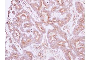 IHC-P Image Immunohistochemical analysis of paraffin-embedded human breast cancer, using NELL1, antibody at 1:250 dilution.