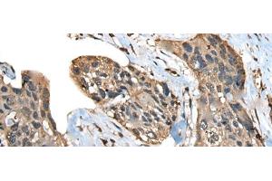 Immunohistochemistry of paraffin-embedded Human esophagus cancer tissue using ATXN3 Polyclonal Antibody at dilution of 1:100(x200) (Ataxin 3 antibody)