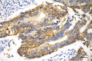 Immunohistochemistry was performed on paraffin-embedded human sigmoid colon carcinoma using catenin beta 1 antibody (ABIN7797931), 1:200). (CTNNB1 antibody)