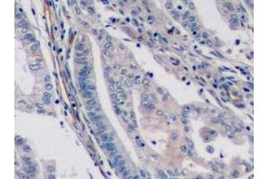 Detection of ENG in Human Endometrial cancer Tissue using Monoclonal Antibody to Endoglin (ENG) (Endoglin antibody  (AA 336-450))