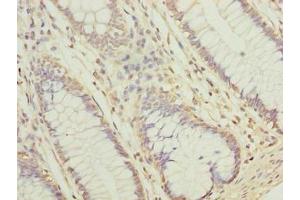 Immunohistochemistry of paraffin-embedded human colon cancer using ABIN7157067 at dilution of 1:100 (NUBPL antibody  (AA 39-319))