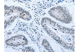 The image on the left is immunohistochemistry of paraffin-embedded Human colon cancer tissue using ABIN7189621(ACIN1 Antibody) at dilution 1/30, on the right is treated with synthetic peptide. (ACIN1 antibody)