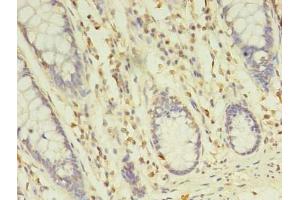 Immunohistochemistry of paraffin-embedded human colon cancer using ABIN7173349 at dilution of 1:100 (TREML2 antibody  (AA 19-268))