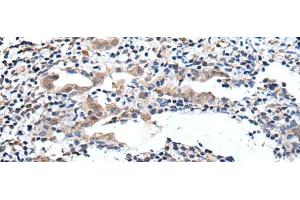 Immunohistochemistry of paraffin-embedded Human cervical cancer tissue using ELMO1 Polyclonal Antibody at dilution of 1:40(x200) (ELMO1 antibody)