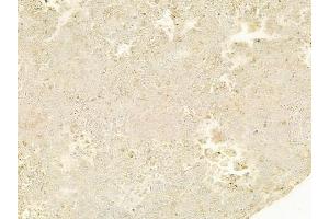 ABIN6263603 and ABIN6278495 at 1/100 staining human melanoma by IHC-P.
