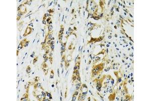 Immunohistochemistry of paraffin-embedded Human colon carcinoma using TNNC1 Polyclonal Antibody at dilution of 1:100 (40x lens). (TNNC1 antibody)