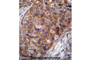 COX7A2L Antibody (Center) immunohistochemistry analysis in formalin fixed and paraffin embedded human breast carcinoma followed by peroxidase conjugation of the secondary antibody and DAB staining. (COX7A2L antibody  (Middle Region))