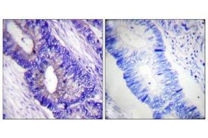 Immunohistochemical analysis of paraffin-embedded human colon carcinoma tissue using PKA α/β CAT (Phospho-Thr197) antibody (left)or the same antibody preincubated with blocking peptide (right). (PRKACA antibody  (pThr197))