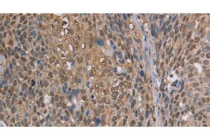 Immunohistochemistry of paraffin-embedded Human cervical cancer using CAB39 Polyclonal Antibody at dilution of 1:50 (CAB39 antibody)