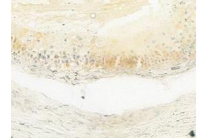 ABIN6264005 and ABIN6279673 at 1/100 staining human testicular cancer by IHC-P. (PABPC3 antibody  (Internal Region))