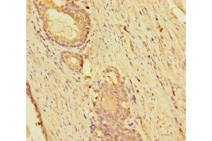 Immunohistochemistry of paraffin-embedded human prostate cancer using ABIN7157298 at dilution of 1:100 (KLHL38 antibody  (AA 1-200))