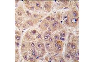 Formalin-fixed and paraffin-embedded human hepatocarcinoma tissue reacted with PIM3 antibody (C-term), which was peroxidase-conjugated to the secondary antibody, followed by DAB staining. (PIM3 antibody  (C-Term))