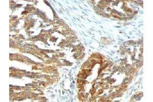 Formalin-fixed, paraffin-embedded human ovarian carcinoma stained with VEGF antibody (VEGF/1063).