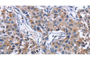 Immunohistochemistry of paraffin-embedded Human lung cancer tissue using MPO Polyclonal Antibody at dilution 1:50 (Myeloperoxidase antibody)