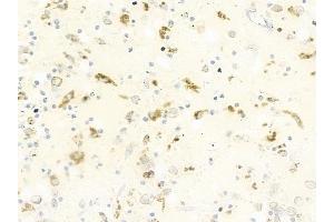 ABIN6264715 and ABIN6279710 at 1/100 staining human melanoma by IHC-P. (RFTN2 antibody  (C-Term))
