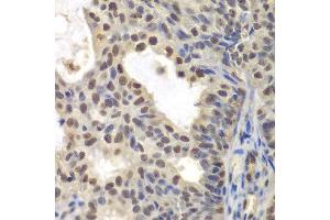 Immunohistochemistry of paraffin-embedded human oophoroma using CENPC antibody at dilution of 1:200 (400x lens).