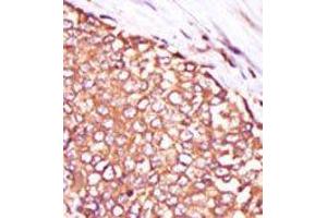 Formalin-fixed and paraffin-embedded human cancer tissue reacted with the primary antibody, which was peroxidase-conjugated to the secondary antibody, followed by DAB staining. (PKC theta antibody  (C-Term))