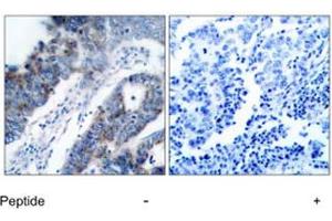 Imunohistochemical analysis of paraffin-embedded human breast carcinoma tissue, using MAP3K5 polyclonal antibody . (ASK1 antibody)