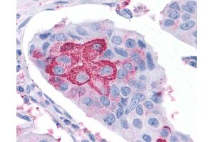 Anti-RORC / ROR Gamma antibody IHC of human Breast, Carcinoma. (RORC antibody  (Ligand Binding Domain))