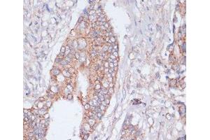 Immunohistochemistry of paraffin-embedded Human colon cancer using MBTPS1 Polyclonal Antibody at dilution of 1:100 (40x lens). (MBTPS1 antibody)