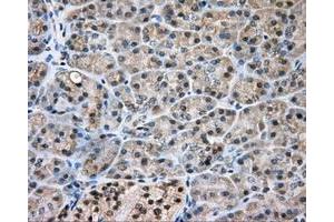 Immunohistochemical staining of paraffin-embedded Adenocarcinoma of colon tissue using anti-NIT2 mouse monoclonal antibody.