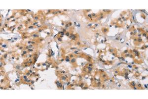 Immunohistochemistry of paraffin-embedded Human thyroid cancer using MARC1 Polyclonal Antibody at dilution of 1:40 (MOSC1 antibody)