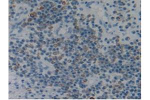 IHC-P analysis of Human Skin Cancer Tissue, with DAB staining. (Fibrillin 1 antibody  (AA 723-902))