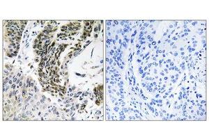 Immunohistochemistry analysis of paraffin-embedded human lung carcinoma tissue using RREB1 antibody. (RREB1 antibody  (Internal Region))