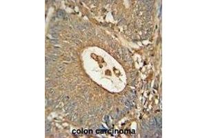 ACOX1 Monoclonal Antibody (ABIN659022 and ABIN2838046) immunohistochemistry analysis in formalin fixed and paraffin embedded human colon carcinoma followed by peroxidase conjμgation of the secondary antibody and DAB staining. (ACOX1 antibody)