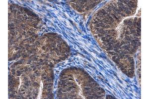 IHC-P Image C6orf97 antibody detects C6orf97 protein at cytoplasm in human endometrial cancer by immunohistochemical analysis. (CCDC170 antibody  (C-Term))