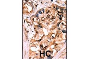 Formalin-fixed and paraffin-embedded human cancer tissue reacted with the primary antibody, which was peroxidase-conjugated to the secondary antibody, followed by AEC staining. (MEK1 antibody  (pSer218, pSer222))