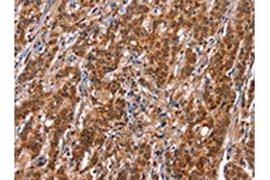 The image on the left is immunohistochemistry of paraffin-embedded Human gastic cancer tissue using ABIN7192753(TDP2 Antibody) at dilution 1/40, on the right is treated with synthetic peptide.