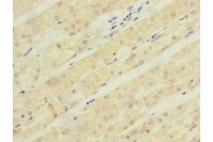 Immunohistochemistry of paraffin-embedded human gastric cancer using ABIN7143005 at dilution of 1:100 (ACCN5 antibody  (AA 140-330))