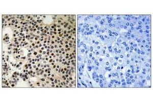 Immunohistochemical analysis of paraffin-embedded human breast carcinoma tissue, using PAK2 (Phospho-Ser197) antibody (left)or the same antibody preincubated with blocking peptide (right). (PAK2 antibody  (pSer197))