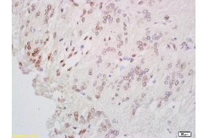 Formalin-fixed and paraffin embedded human cervial carcinoma labeled with Anti-CREB-1 Polyclonal Antibody, Unconjugated (ABIN723965) at 1:200 followed by conjugation to the secondary antibody and DAB staining. (CREB1 antibody  (AA 101-150))
