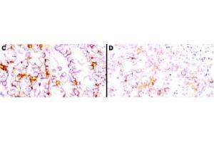 Immunohistochemistry (IHC) image for anti-Mesothelin (MSLN) (Extracellular Domain) antibody (ABIN400815) (Mesothelin antibody  (Extracellular Domain))