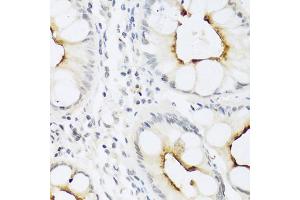 Immunohistochemistry of paraffin-embedded human colon using CCL22 antibody (ABIN5974972) at dilution of 1/100 (40x lens). (CCL22 antibody)