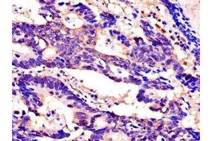 Immunohistochemistry of paraffin-embedded human colon cancer using ABIN7168925 at dilution of 1:100 (SPINK1 antibody  (AA 19-79))