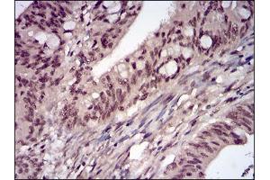 Immunohistochemical analysis of paraffin-embedded rectum cancer tissues using PPP1CB mouse mAb with DAB staining.