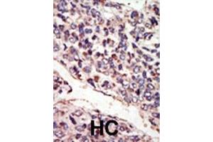 Formalin-fixed and paraffin-embedded human cancer tissue reacted with the primary antibody, which was peroxidase-conjugated to the secondary antibody, followed by DAB staining. (NTRK3 antibody  (N-Term))