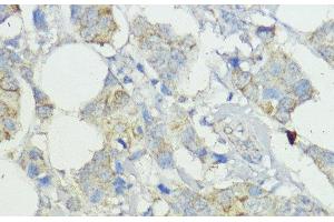 Immunohistochemistry of paraffin-embedded Human mammary cancer using SOCS6 Polyclonal Antibody at dilution of 1:100 (40x lens).