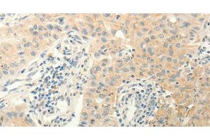 Immunohistochemistry of paraffin-embedded Human lung cancer using ERG Polyclonal Antibody at dilution of 1:40