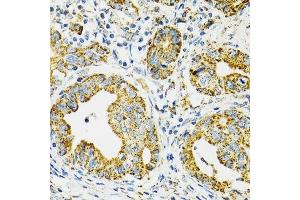 Immunohistochemistry of paraffin-embedded human gastric cancer using HSPA9 antibody. (HSPA9 antibody  (AA 380-679))