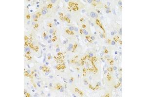 Immunohistochemistry of paraffin-embedded human liver cancer using FAS Antibody (ABIN5970062) at dilution of 1/100 (40x lens). (FAS antibody)
