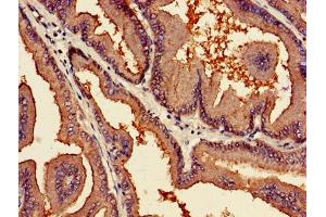 Immunohistochemistry of paraffin-embedded human prostate cancer using ABIN7163761 at dilution of 1:100 (PARN antibody  (AA 1-639))