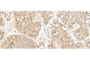 Immunohistochemistry of paraffin-embedded Human prost at e cancer tissue using ATL3 Polyclonal Antibody at dilution of 1:85(x200)