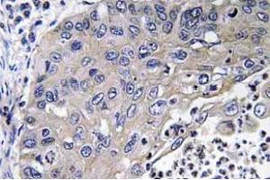 Immunohistochemistry (IHC) analyzes of Cathepsin D antibody in paraffin-embedded human lung carcinoma tissue. (Cathepsin D antibody)